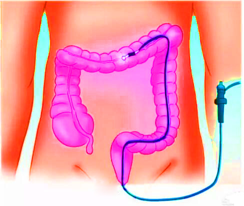 直腸癌早期有哪些癥狀？